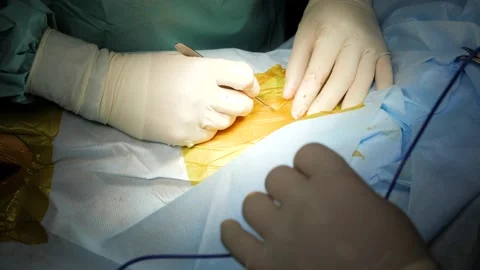 Surgeon's hands in sterile gloves performing operation with surgery tools. Stock Footage 132496879