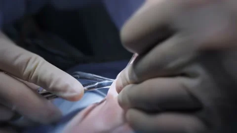 Surgeon's hands while performing plastic surgery on nose Stock Footage 150553592