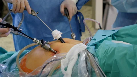 Surgeons hands working during laparoscopic surgery Video stock 106983342