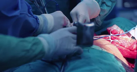 Surgeons operating and being given surgical scissors in real operation Stock Footage 146163013