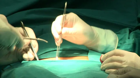 Surgeons operating Stock Footage 39859299