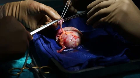Surgeons operating the kidney of a patient Stock Footage 85939465