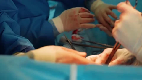 Surgeons in the operating room perform an operation on a patient. A complex Stock Footage 219890348