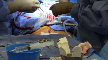 Surgeons in operation Stock Footage 85925864