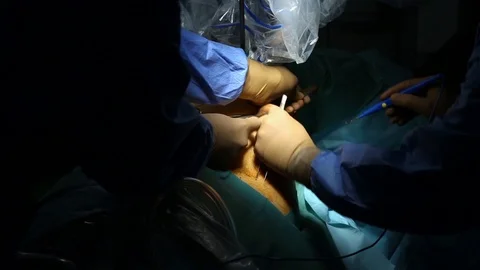 Surgeons in operation Stock Footage 85927540