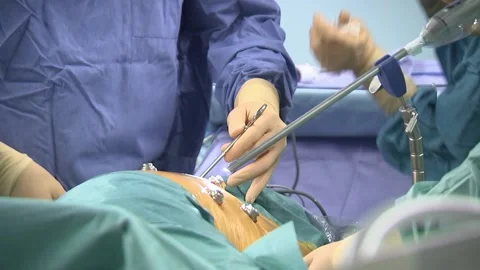 Surgeons perform laparoscopic abdominal surgery. Stock Footage 148148696