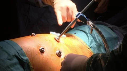 Surgeons perform a laparoscopic surgery. Clouse-up of doctor's hands and the Stock Footage 151131858