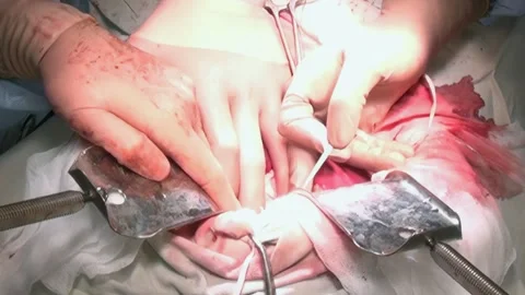 Surgeons Perform Life-Saving Operation in Hospital During Late Night Hours Stock Footage 280929667