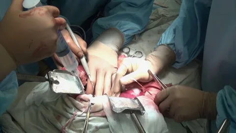 Surgeons perform meticulous procedure inside operating room at hospital 库存影片 317279407