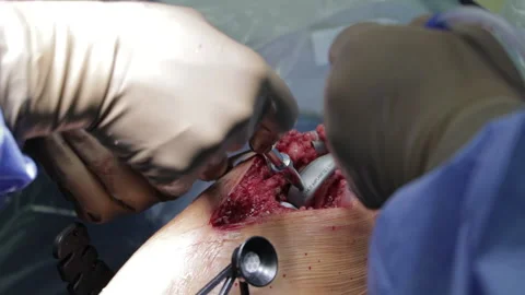 Surgeons perform the operation with a modern robot. Video stock 164118169