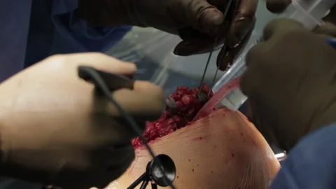 Surgeons perform the operation with a modern robot. Video stock 164118259