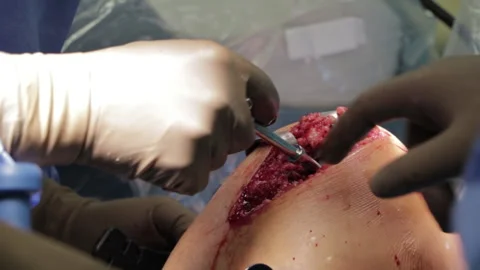 Surgeons perform the operation with a modern robot. Video stock 164118310