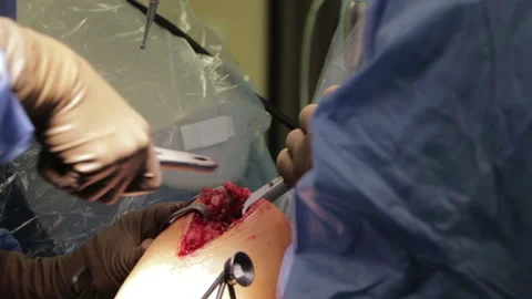 Surgeons perform the operation with a modern robot. Video stock 164118314