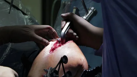 Surgeons perform the operation with a modern robot. Video stock 164118328