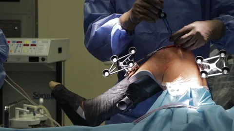 Surgeons perform the operation with a modern robot. Video stock 164118395