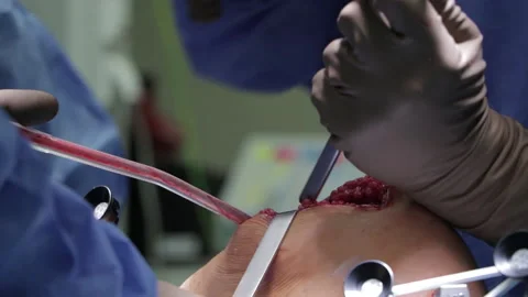 Surgeons perform the operation with a modern robot. Video stock 164118437
