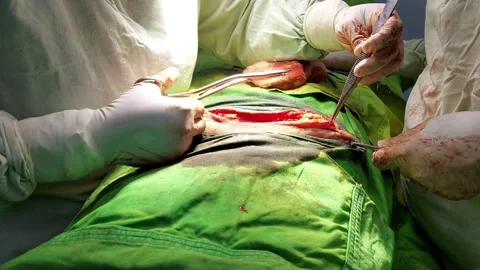 Surgeons performing abdominal operation Stock-Footage 246980883