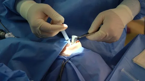 Surgeons performing delicate ear procedure in operating room Stock Footage 316400239