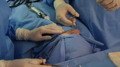 Surgeons performing delicate nose surgery in operating room Stock Footage 316400384