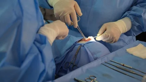 Surgeons performing delicate nose surgery in operating room Stock Footage 316400409
