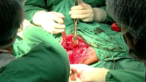 Surgeons performing explicit operation of hip replacement in operating room Stock Footage 10876469