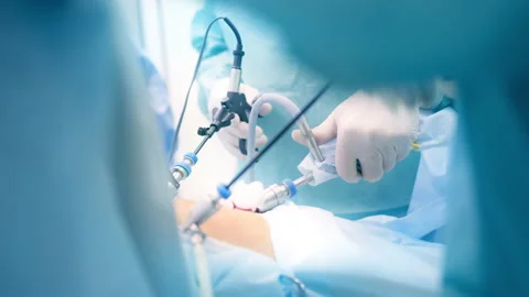 Surgeons Performing Laparoscopic Surgery. Close-Up of Medical Instruments in Stock Footage 296929491