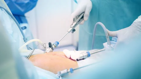 Surgeons Performing Laparoscopic Surgery with Specialized Instruments in a S Stock Footage 296929630