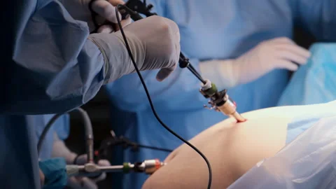 Surgeons performing laparoscopic surgery using advanced medical instruments Stock Footage 306168105