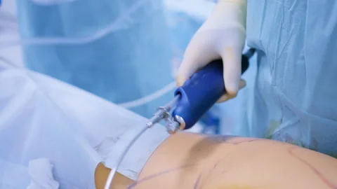 Surgeons Performing Liposuction with Cannula on Marked Abdomen in Operating  Stock Footage 308420335
