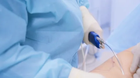 Surgeons Performing Liposuction with Cannula on Marked Abdomen in Operating  Stock Footage 308420414