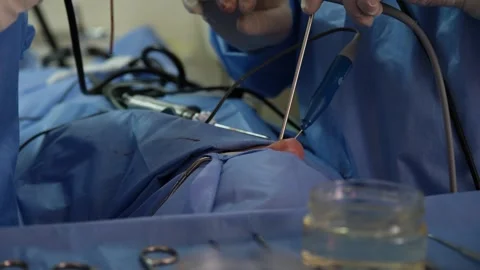 Surgeons performing minimally invasive surgery Stock Footage 316400002
