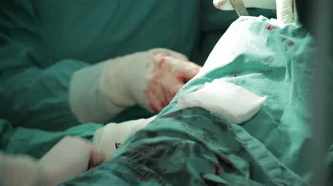 Surgeons performing operation in operating room, hands with hammer close up. Stock Footage 50985927