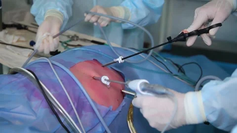 Surgeons team hands during laparoscopic abdominal operation. Stock Footage 245610127