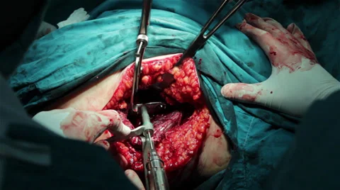 Surgeons team performing hip operation in operating theatar, incision close up Stock Footage 34628129