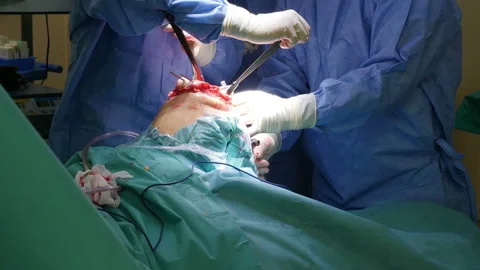 Surgeons team performing knee replacement operation Stock Footage 92316606