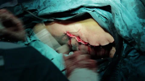 Surgeons team performing operation in hospital operating room,incision close up 스톡 동영상 34635546