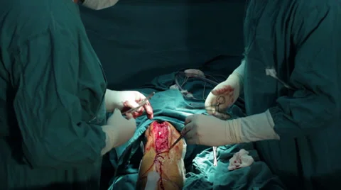 Surgeons team performing operation in operating room, tilt up, stitched close up Stock Footage 34924359