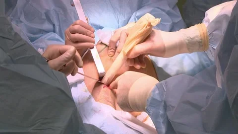 Surgeon's team performs an abdominal operation in a hospital operating room with Stock Footage 151131837