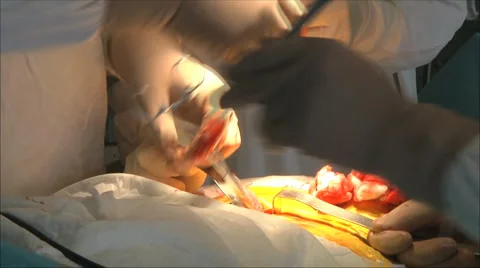 Surgery 2 Stock Footage