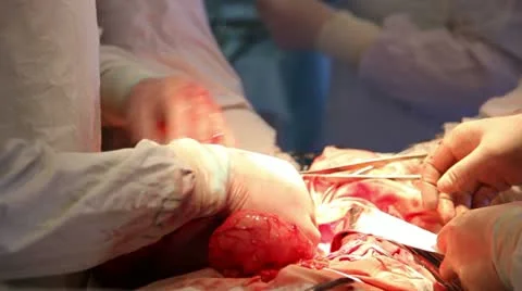 Surgery on the abdomen in a sterile operating 2 스톡 동영상 21944441