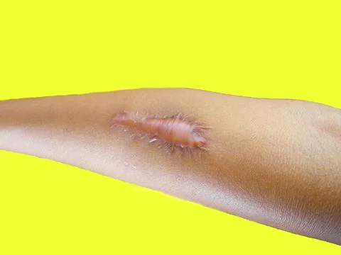 Surgery on the arm Separate 写真素材