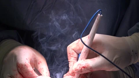 Surgery being performed by professionals Stock Footage 239698971