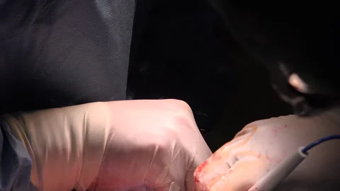 Surgery being performed by professionals using electrosurgical pencil Stock Footage 239699600