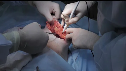 Surgery close-up. Electrosurgery. Plastic surgery Stock Footage 220519561