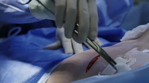 Surgery close-up. Hands of a doctor preparing wound before breast augmentation Vídeos de archivo 221189271