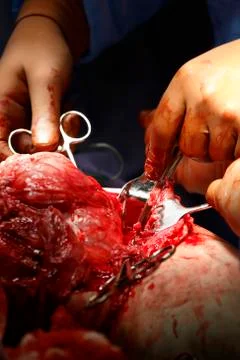 Surgery close-up Stockfoto's