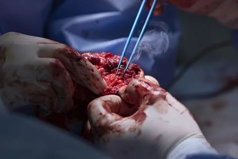 Surgery closeup with electrosurgical forceps using on open tissues during han Фото