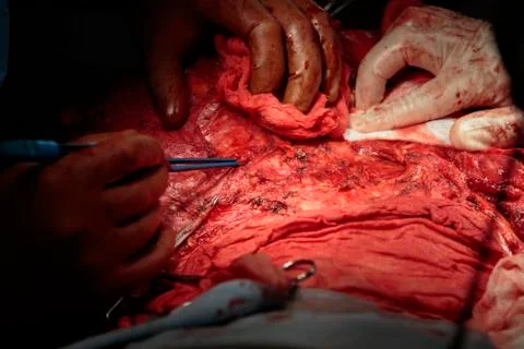 Surgery with coagulation 写真素材