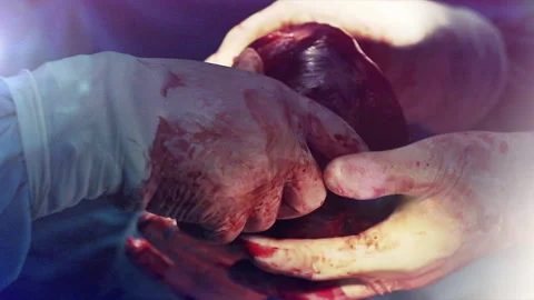 Surgery collection of surgeons operating with reflections on surgical eyewear Stock Footage 146905486