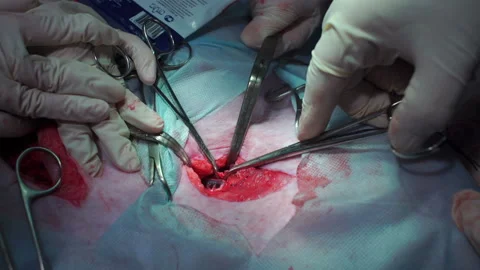 Surgery. The doctor's hands cut the artery with scissors Stock Footage 91610622